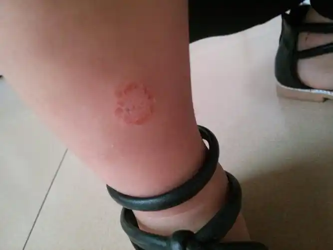 请懂得皮肤病的高手看看我女儿腿上长得是金钱癣吗?急急急,谢谢了!