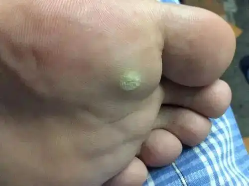 脚上长鸡眼图片有了鸡眼可以怎么处理