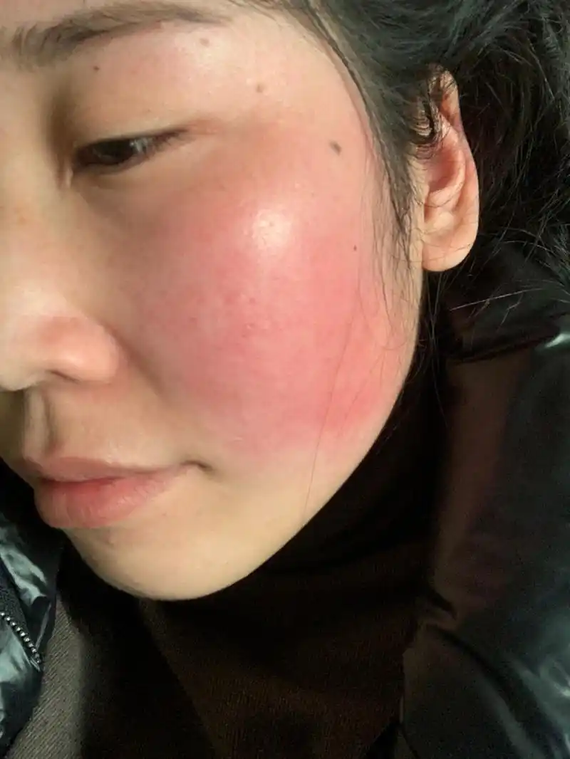 脸每天都是红的,平时红但没什么感觉,预热冷空调房