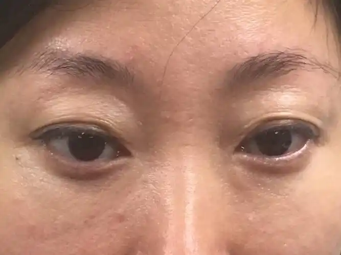 我今年***,想咨询上眼睑松弛的手术.