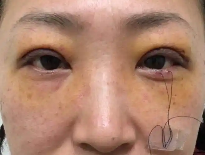 左眼上睑下垂矫正双眼重睑术照片