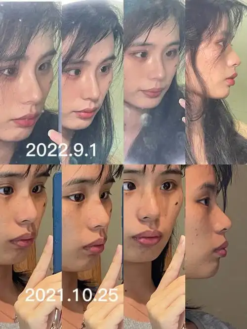 牙套一年变化以及一些常见问题现身说法