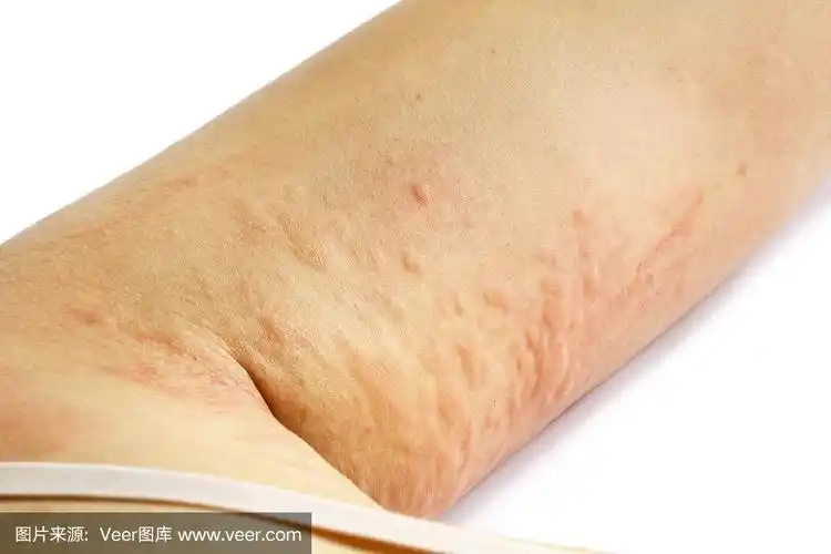 患者手臂过敏性皮疹皮肤