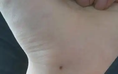 手腕处有痣代表了什么 是好是坏?