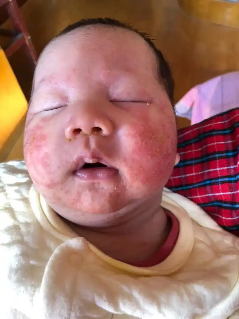 湿疹宝宝.带大过敏湿疹宝宝不容易,天天皮肤护理,饮食规律,还 - 抖音