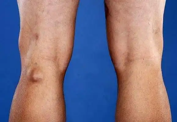 常见膝关节囊肿有哪些是否必须手术治疗会恶变吗医生告诉您