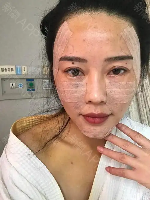 自体脂肪面部填充