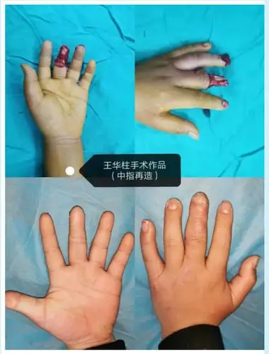 3d打印辅助再造完美手指