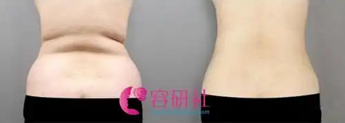 腰腹吸脂手术前后效果对比