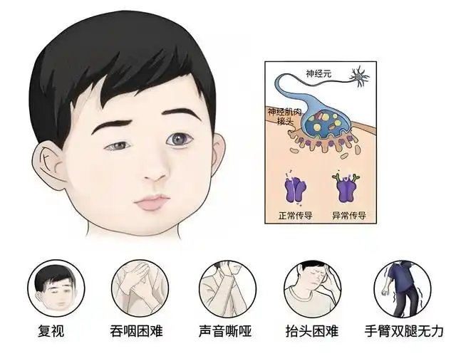 重症肌无力的一些症状