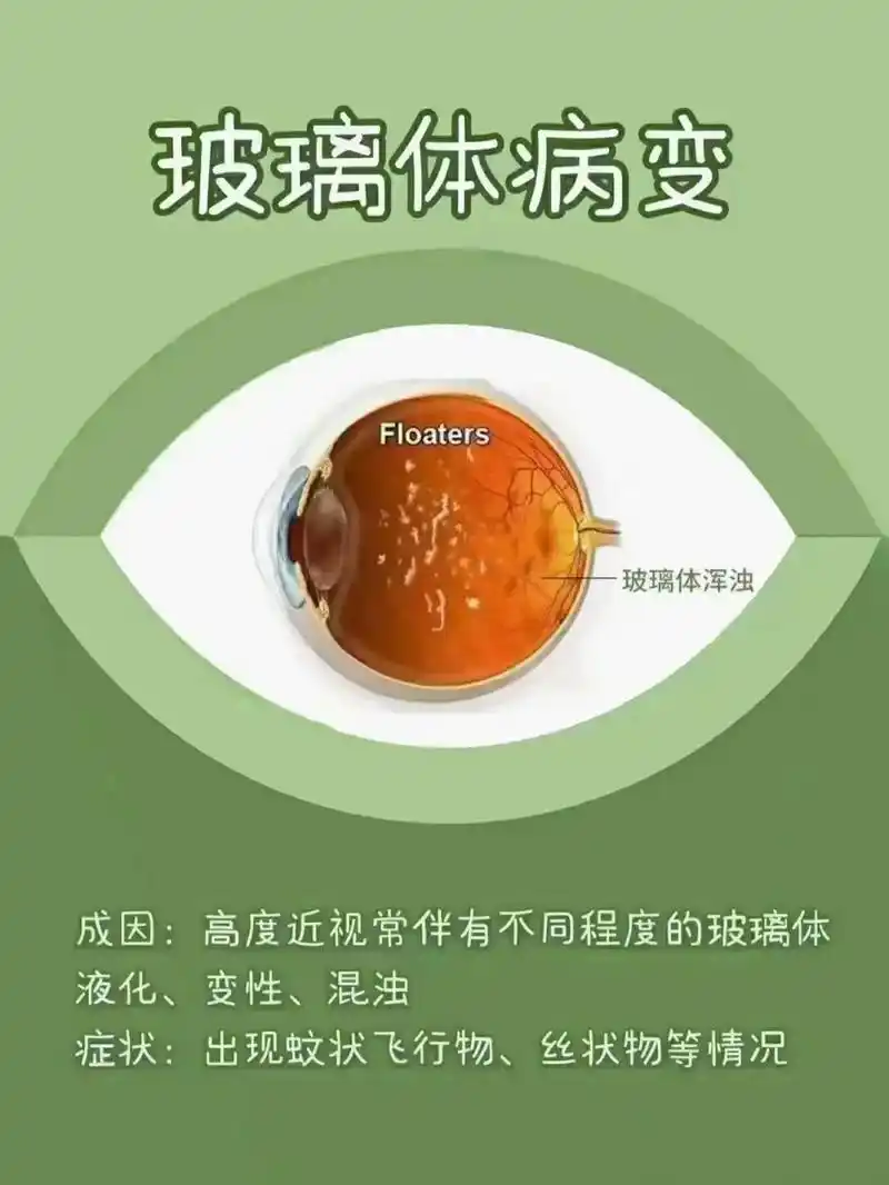 家长们让我们一起来了解高度近视的危害.