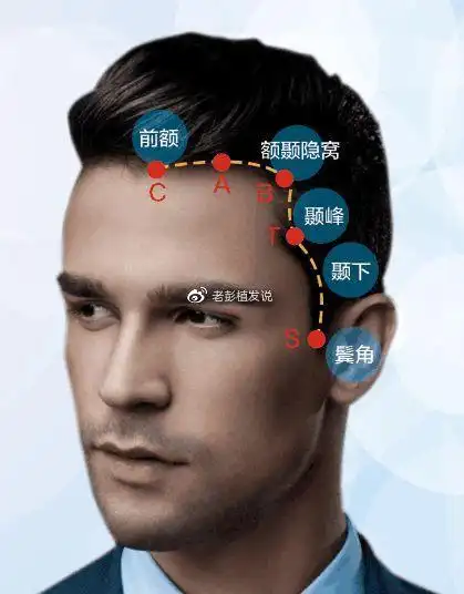 颞角,就是颞叶的前部,呈三角状,将发际线和鬓角连接.