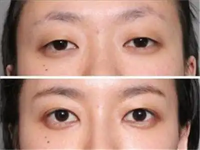 眼睑下垂指的是上面的眼睑下垂,通常表现为上眼睑部分或者完全不