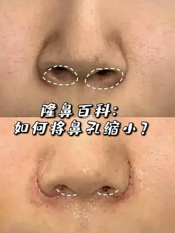 鼻孔缩小