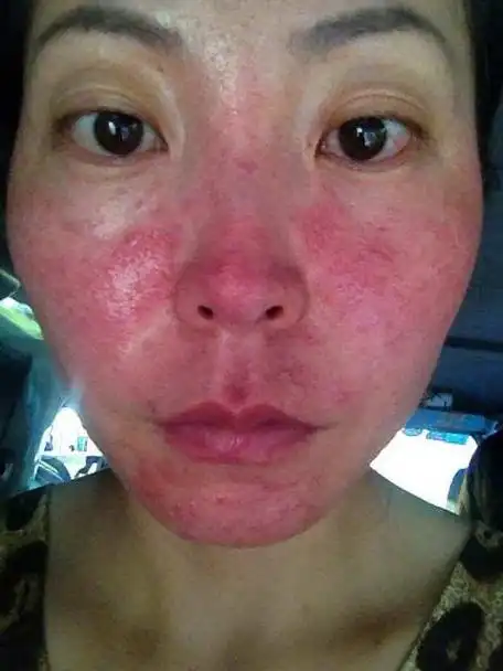 脸为什么会有红血丝 为什么脸部会有红血丝