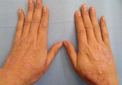 各种癣的症状图片及名称_银屑病求医网