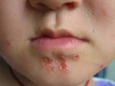 注意脓疱疮此病好发于夏季儿童多见具有传染性