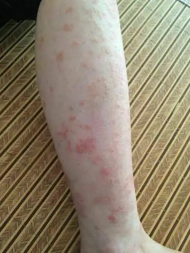 腿部调理前照片