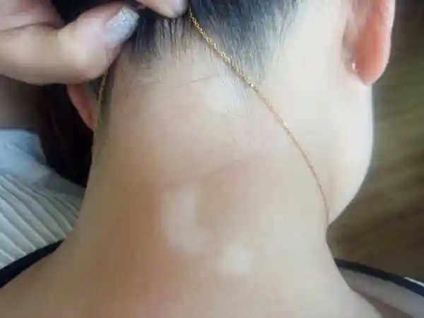 脖子上突然出现一片一片的白色,是怎么回事?