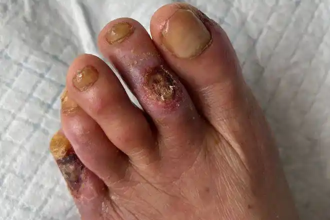 男子患糖尿病20年,因为这点不注意,差点被截肢!_爷爷_患者_进行