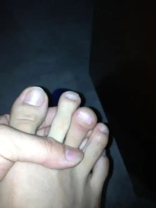 脚中趾成杵状指已经十几年了,本人今年24岁,有时候会酸痛,请问这是