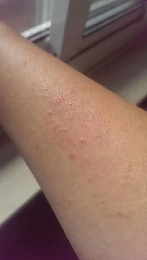 最近天气比较湿热,上臂上长了一些小疙瘩,比较痒,有点像皮炎,用皮炎平