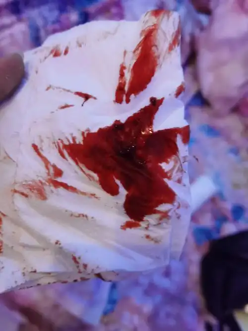 [试管婴儿]夜里毫无征兆的出血了,量还多