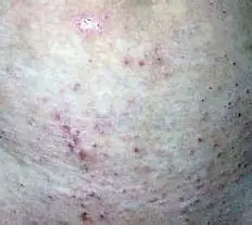 小偏方治疗男性阴囊瘙痒轻松排解您的烦恼