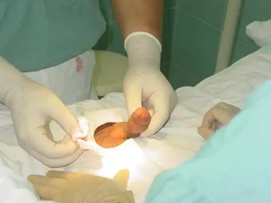 包皮过长图片大全 (8)