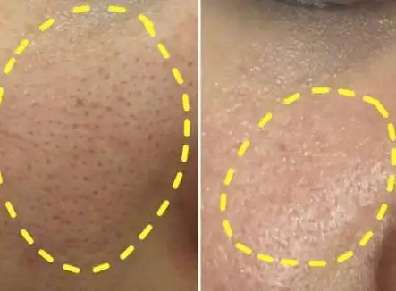 黑头又称黑头粉刺,为开放性粉刺,皮肤油脂在空气中的氧化而造成,发臭