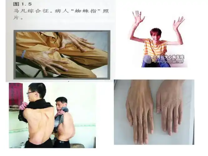 马凡氏综合症护理查房ppt