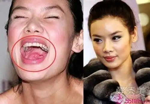 谢娜佟丽娅王珞丹一口烂牙毁掉高颜值