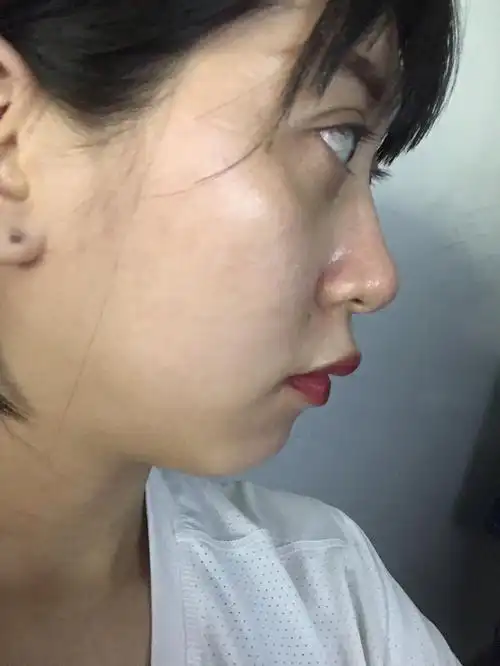 侧脸不好看 这是眼袋还是由于近视的眼睛变形 还有得救吗