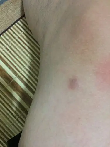 大腿接近膝盖上方长个肉包,懂的帮我看看,不痒不痛,按着有点痛.