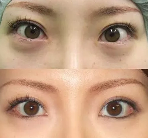 芜湖伊莱做眼睑下至怎么样