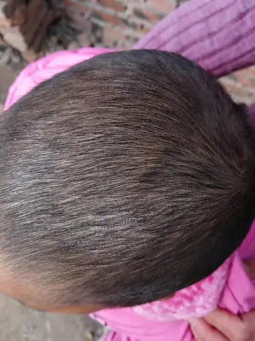 一岁宝宝头皮看着有干皮,看着像头皮屑,就一块地方有,是不是皮肤问题?