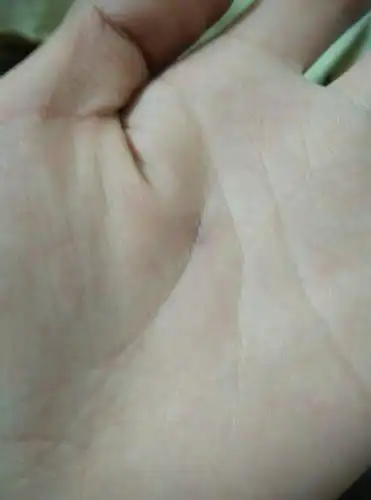 为什么我手心有个鸡眼睛