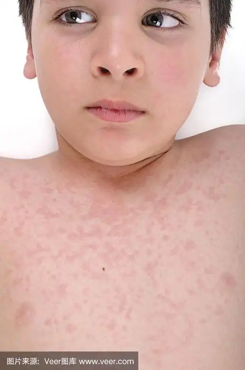 患有荨麻疹的儿童身体