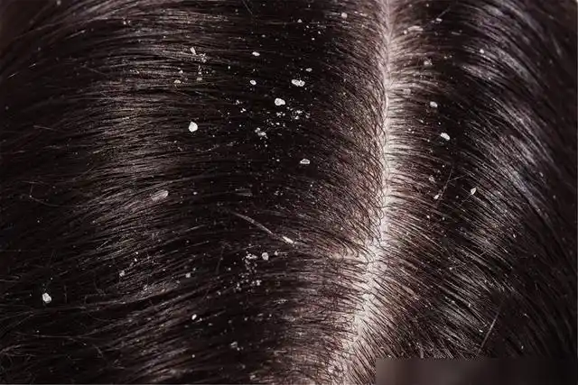 头皮屑,怎能让你静静地飘|洗发水|毛孔|干性皮肤|皮脂腺_网易订阅