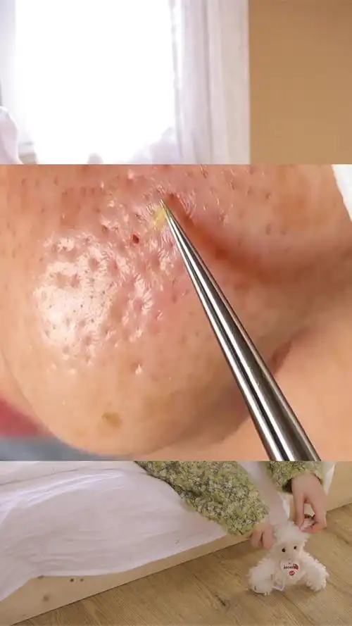 脸上都是黑头粉刺,推荐这款去黑头神器,不伤皮肤!