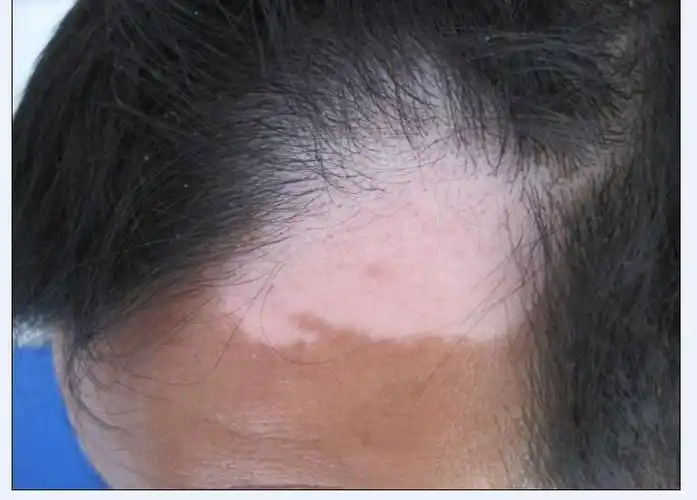 皮损颜色:在不同的发病时期,白癜风的皮损颜色是不同的.