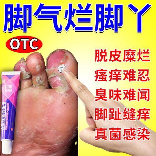 药】脚气膏止痒脱皮烂脚丫脚根气治真菌感染止痒水泡型脚气脚臭脚出汗