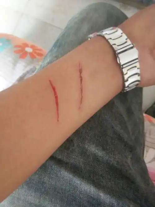 上有伤口,不要涂抹或者让伤口沾到粉状物,这样的情况会造成疤痕增生