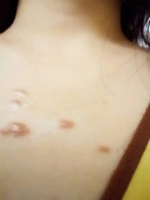 背上和肩膀上长了这些疙瘩好多年了,去医院检查医生说是毛囊炎,开了
