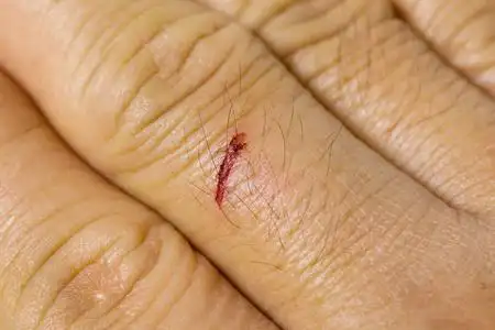 新鲜的伤口关闭在中指的新鲜小伤口照片