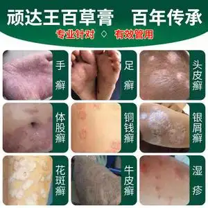 牛皮癣银屑病湿疹皮肤病止痒去根皮炎瘙痒外用藓特效抑菌百草药膏