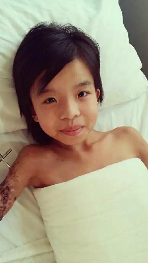 李皖湘在放学的路上遭遇车祸,导致右腿高位截肢,右臂严重骨折并断了三