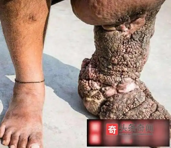 世界最恶心的十种病世界上十大奇葩病