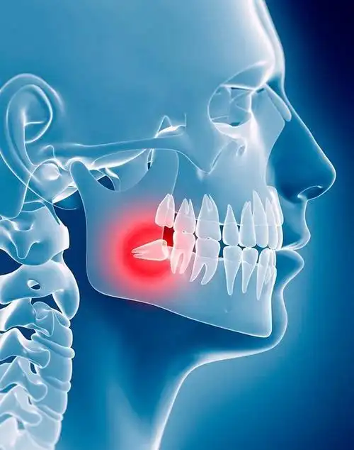 智齿大揭秘!这些危害你绝对不能忽视!