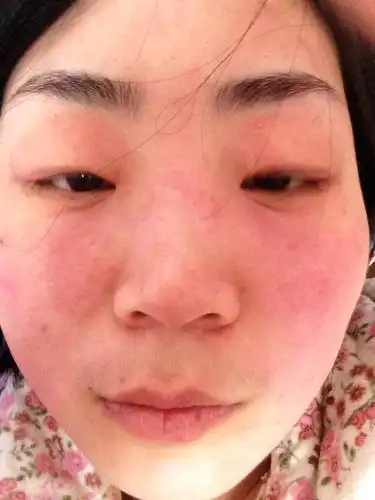 面部皮肤过敏症的预防护理